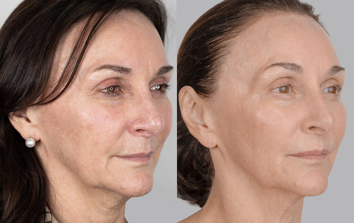 Shirley Ballas before and after half profile med res