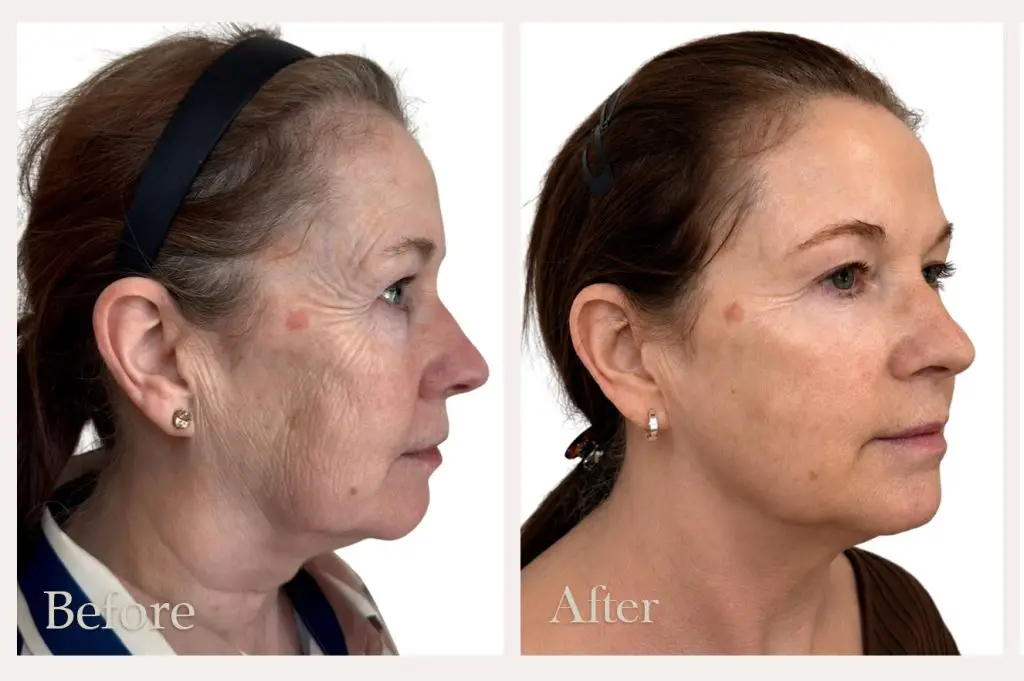 NeoGen Facial Rejuvenation Before & After Results Dorset