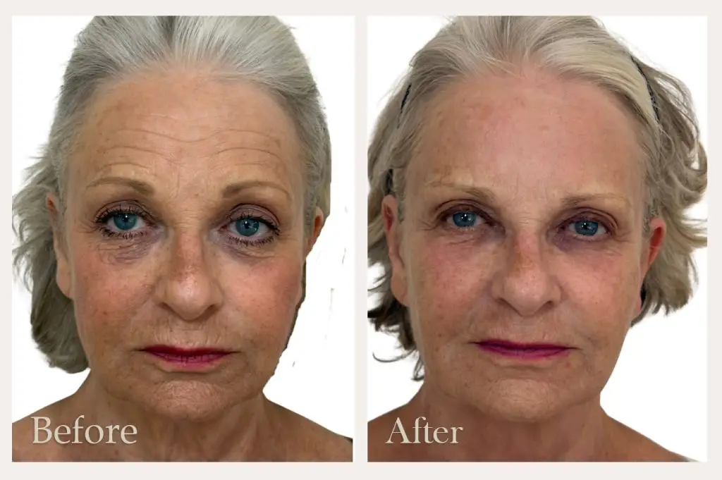 NeoGen Facial Rejuvenation Before & After Results from Dorset based clinic