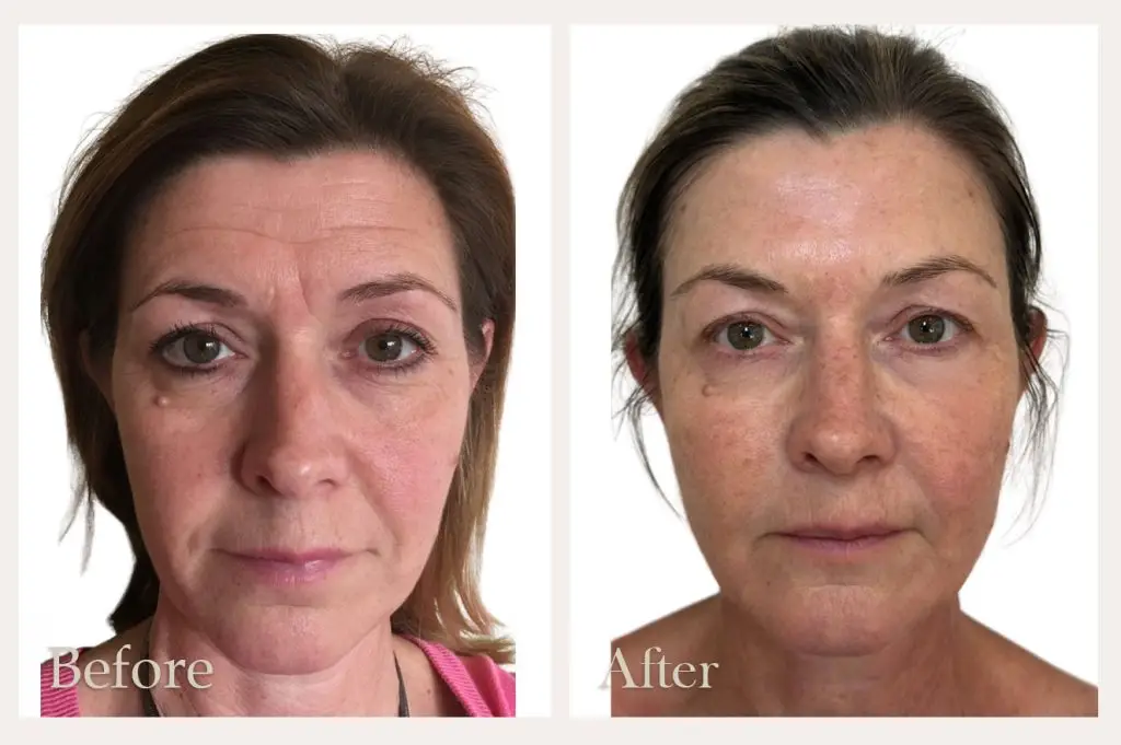 NeoGen Facial Treatment Before & After Results from Wimborne based clinic