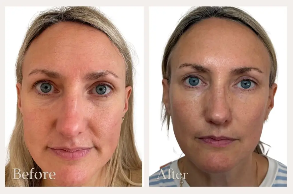 NeoGen Facial Rejuvenation Treatment Before & After Results from Wimborne based clinic