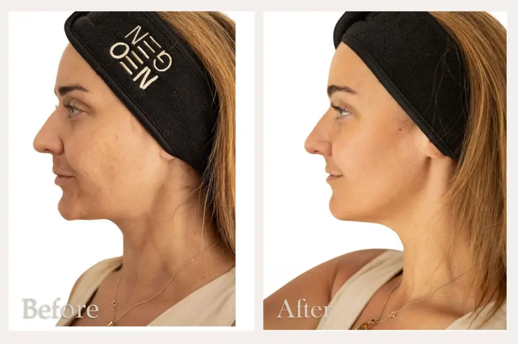 NeoGen Facial Rejuvenation Treatment Before & After Results from Dorset clinic