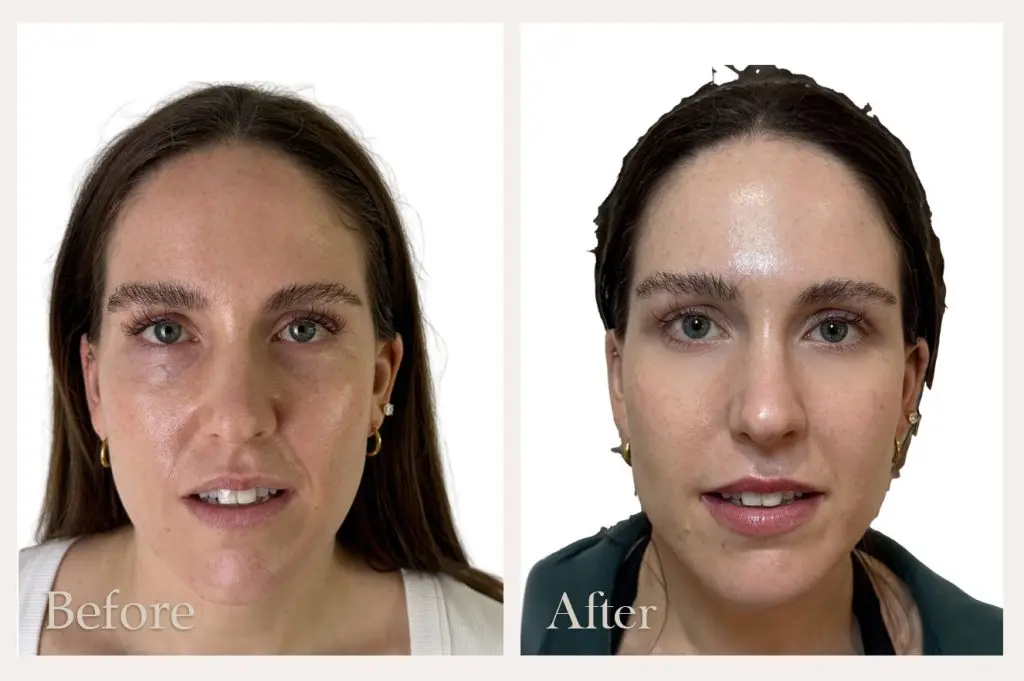 NeoGen Face Rejuvenation Treatment Before & After Results from Dorset clinic