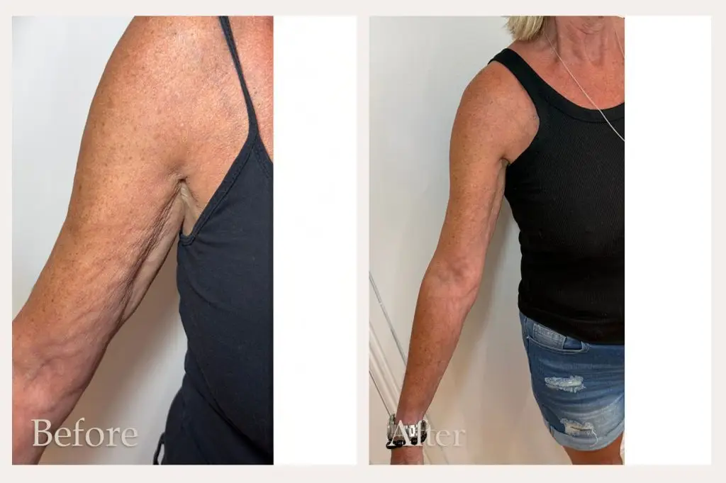 NeoGen upper arm rejuvenation & firming treatment Before & After Results from Dorset clinic